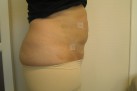 1 månad efter fettsugning